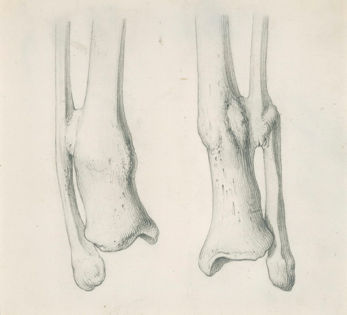 Gerard van der Gucht, Two drawings of a tibia and fibula joined by a callous, for Cheselden's Osteographia