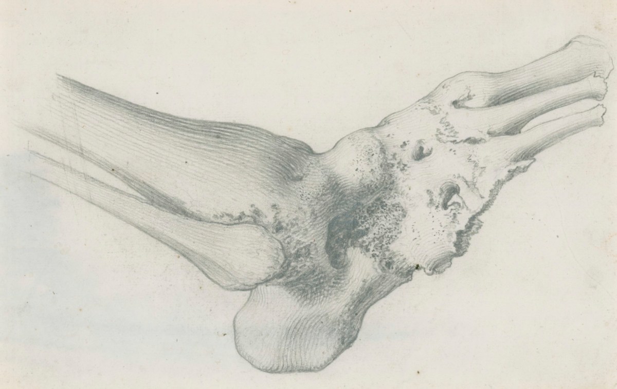 Gerard van der Gucht, An anchylosis of the bones of the foot for Cheselden's Osteographia