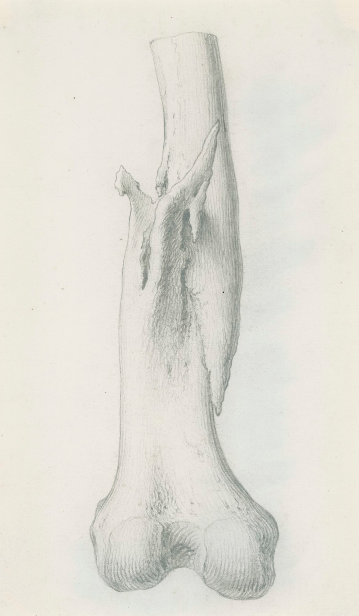 Gerard van der Gucht, A fracture of the lower end of the thigh bone, for Cheselden's Osteographia