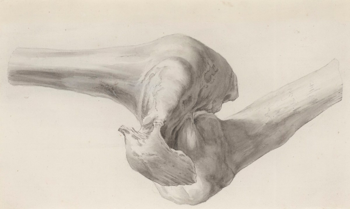 Jacob Schijnvoet, Diseased bones of the leg (?), relating to Cheselden's Osteographia